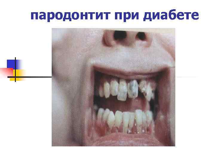 пародонтит при диабете 