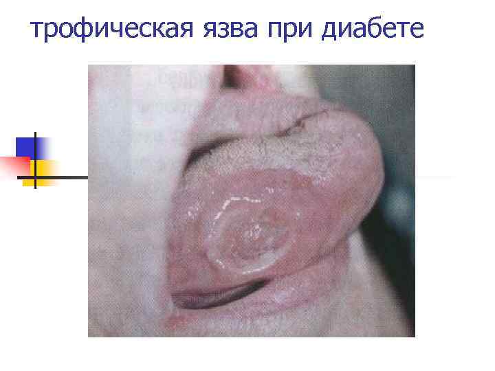трофическая язва при диабете 