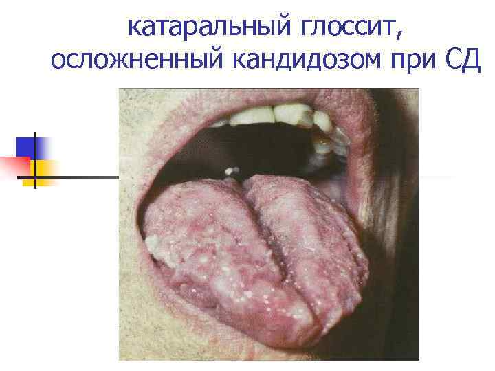 катаральный глоссит, осложненный кандидозом при СД 