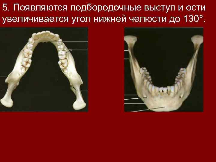 5. Появляются подбородочные выступ и ости увеличивается угол нижней челюсти до 130°. 