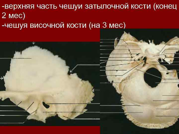 -верхняя часть чешуи затылочной кости (конец 2 мес) -чешуя височной кости (на 3 мес)