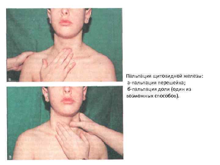 Пальпация щитовидной железы: а пальпация перешейка; б пальпация доли (один из возможных способов). 