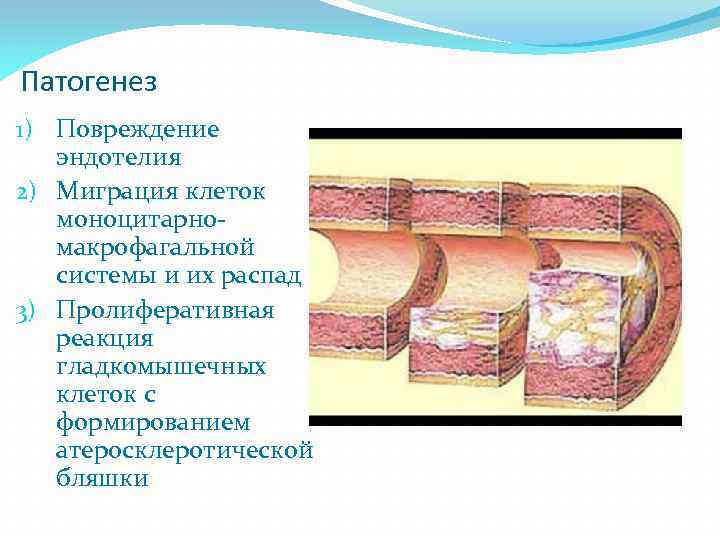 Патогенез 1) Повреждение эндотелия 2) Миграция клеток моноцитарномакрофагальной системы и их распад 3) Пролиферативная