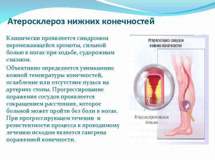 Атеросклероз нижних конечностей Клинически проявляется синдромом перемежающейся хромоты, сильной болью в ногах при ходьбе,