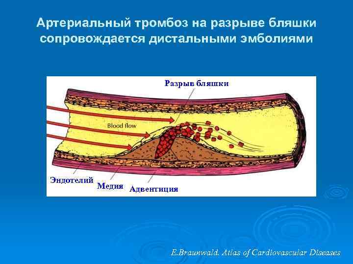 Артериальный тромбоз на разрыве бляшки сопровождается дистальными эмболиями Разрыв бляшки Эндотелий Медия Адвентиция E.