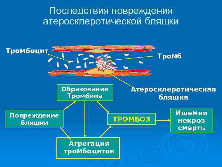 Последствия повреждения атеросклеротической бляшки Тромбоцит Тромб Атеросклеротическая бляшка Образование Тромбина Повреждение бляшки ТРОМБОЗ Агрегация