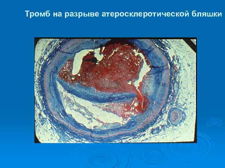 Тромб на разрыве атеросклеротической бляшки 
