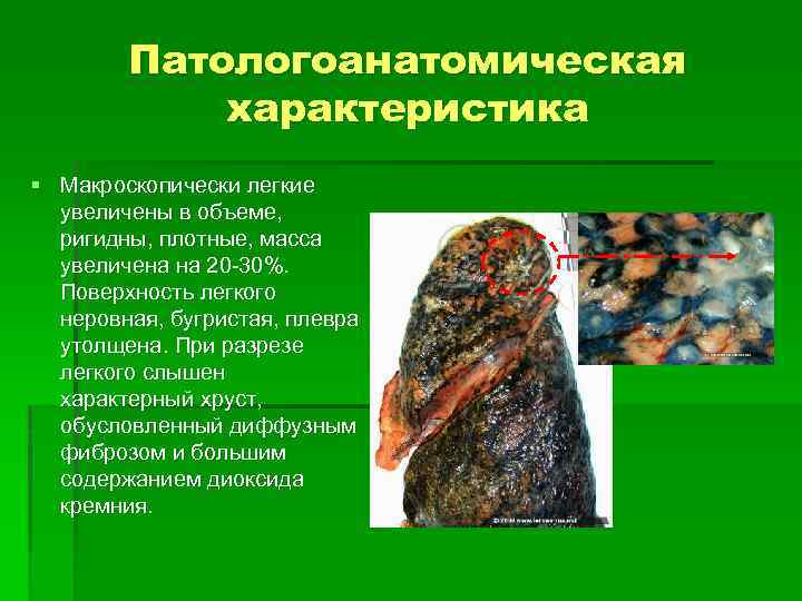 Патологоанатомическая характеристика § Макроскопически легкие увеличены в объеме, ригидны, плотные, масса увеличена на 20