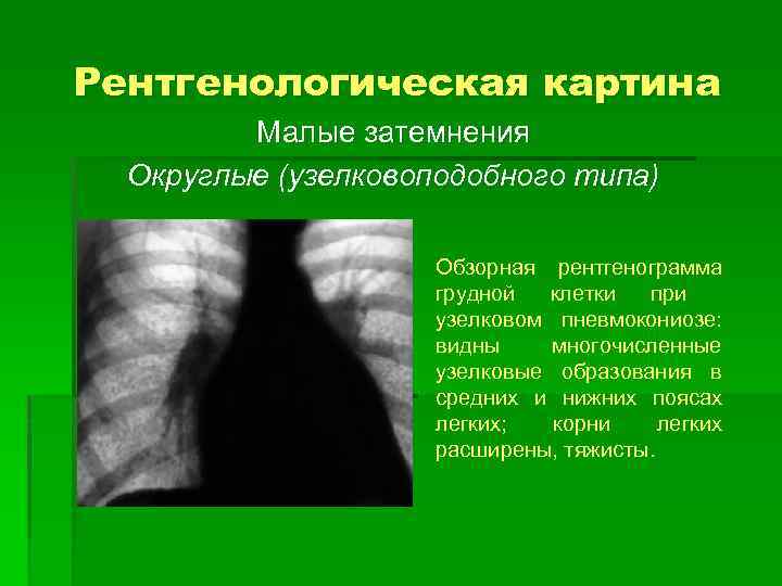 Рентгенологическая картина Малые затемнения Округлые (узелковоподобного типа) Обзорная рентгенограмма грудной клетки при узелковом пневмокониозе: