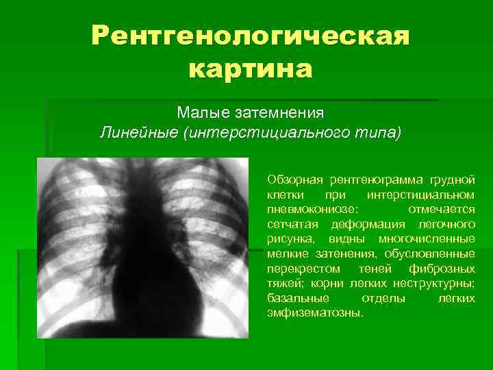 Рентгенологическая картина Малые затемнения Линейные (интерстициального типа) Обзорная рентгенограмма грудной клетки при интерстициальном пневмокониозе: