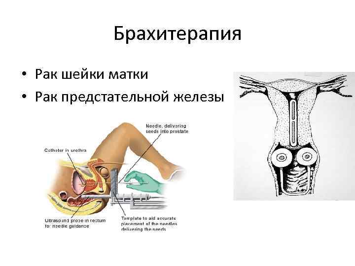 Брахитерапия • Рак шейки матки • Рак предстательной железы 