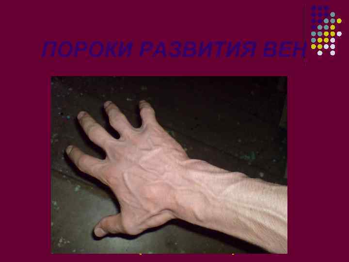 ПОРОКИ РАЗВИТИЯ ВЕН 