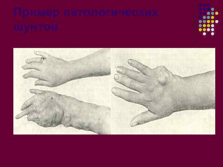 Пример патологических шунтов 