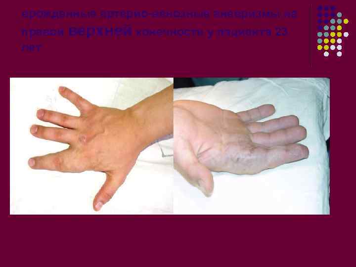 врожденные артерио-венозные аневризмы на правой верхней конечности у пациента 23 лет 
