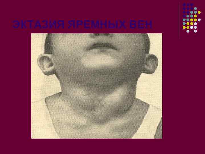 ЭКТАЗИЯ ЯРЕМНЫХ ВЕН 
