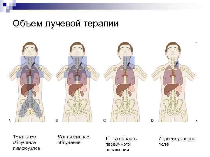Объем лучевой терапии Тотальное облучение лимфоузлов Мантьевидное облучение ЛТ на область первичного поражения Индивидуальное