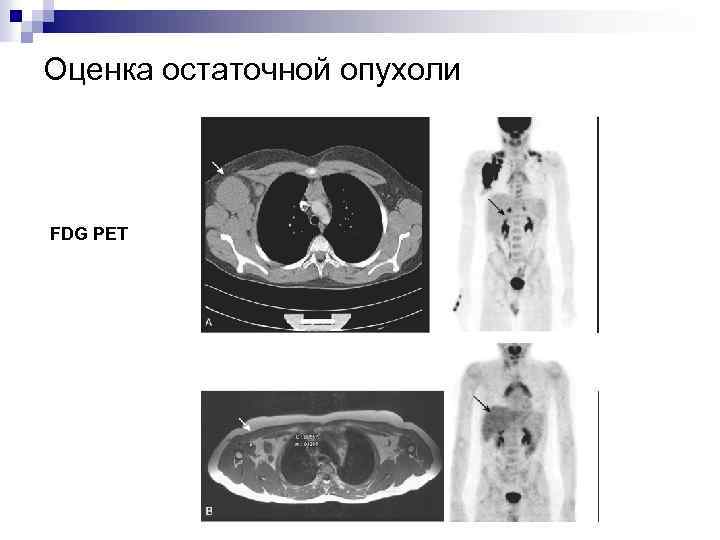 Оценка остаточной опухоли FDG PET 