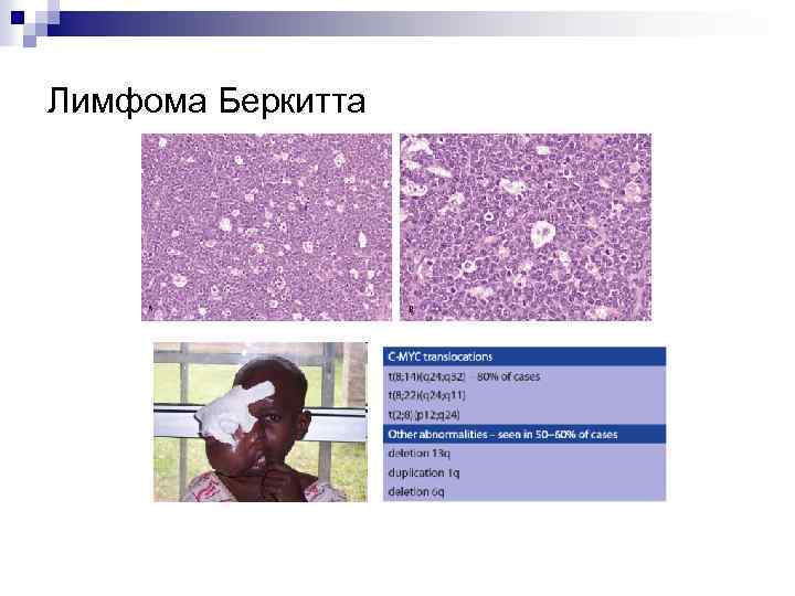 Лимфома Беркитта 