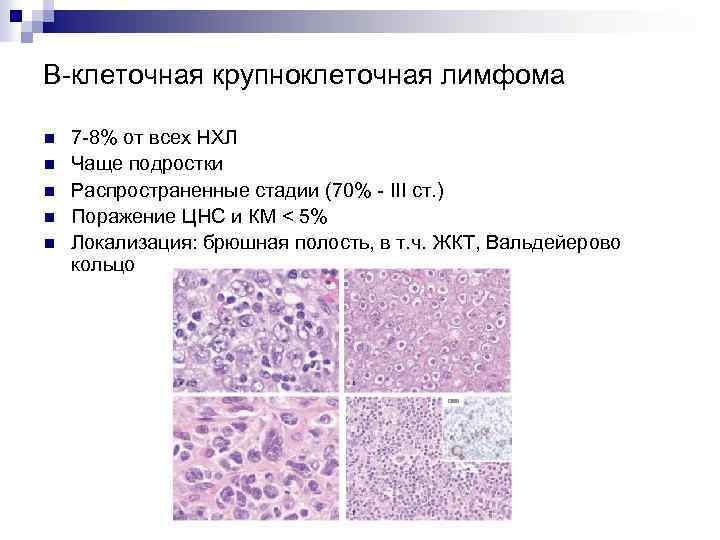 В-клеточная крупноклеточная лимфома n n n 7 -8% от всех НХЛ Чаще подростки Распространенные