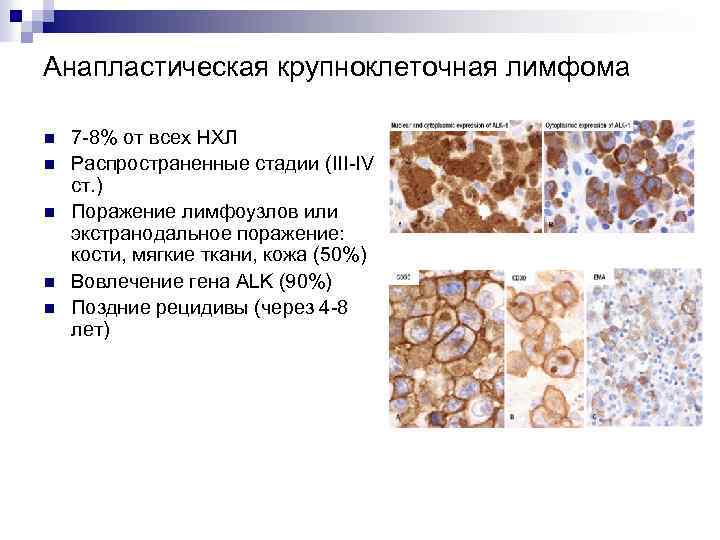 Анапластическая крупноклеточная лимфома n n n 7 -8% от всех НХЛ Распространенные стадии (III-IV