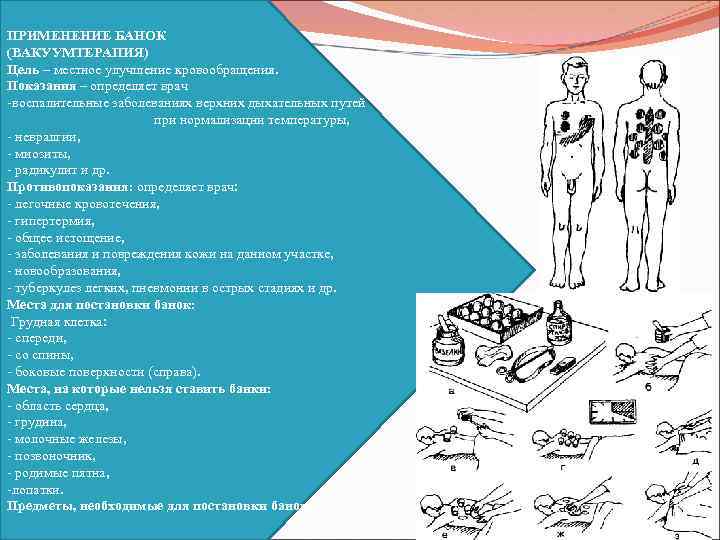 ПРИМЕНЕНИЕ БАНОК (ВАКУУМТЕРАПИЯ) Цель – местное улучшение кровообращения. Показания – определяет врач воспалительные заболеваниях