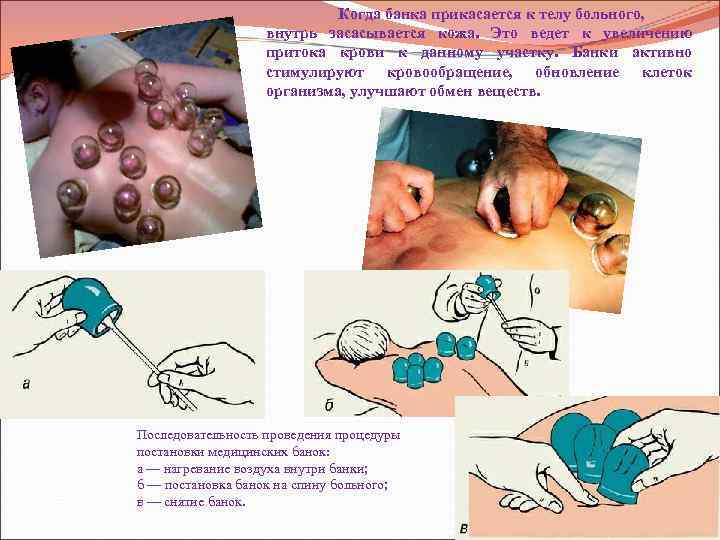 Когда банка прикасается к телу больного, внутрь засасывается кожа. Это ведет к увеличению притока