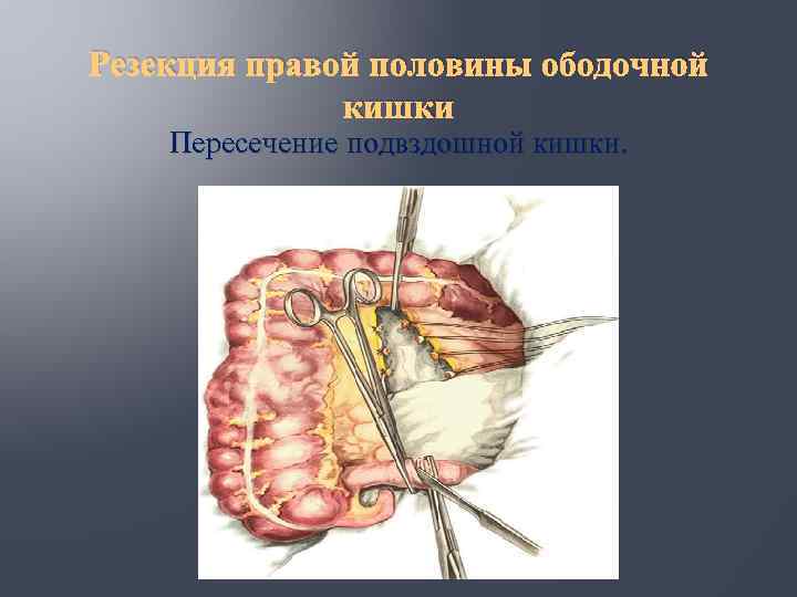 Резекция правой половины ободочной кишки Пересечение подвздошной кишки. 