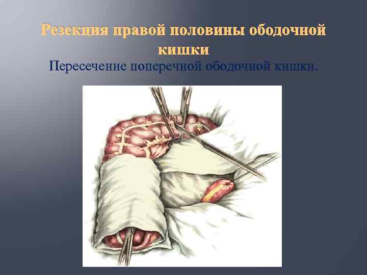 Резекция правой половины ободочной кишки Пересечение поперечной ободочной кишки. 