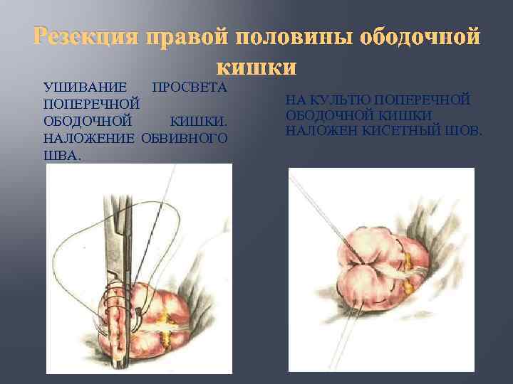 Резекция правой половины ободочной кишки УШИВАНИЕ ПРОСВЕТА ПОПЕРЕЧНОЙ ОБОДОЧНОЙ КИШКИ. НАЛОЖЕНИЕ ОБВИВНОГО ШВА. НА