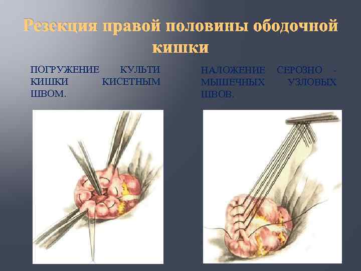 Кровоснабжение толстой кишки схема