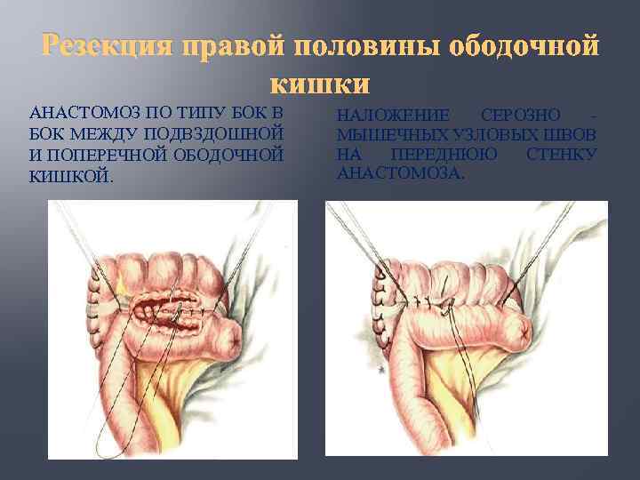 Резекция правой половины ободочной кишки АНАСТОМОЗ ПО ТИПУ БОК В БОК МЕЖДУ ПОДВЗДОШНОЙ И