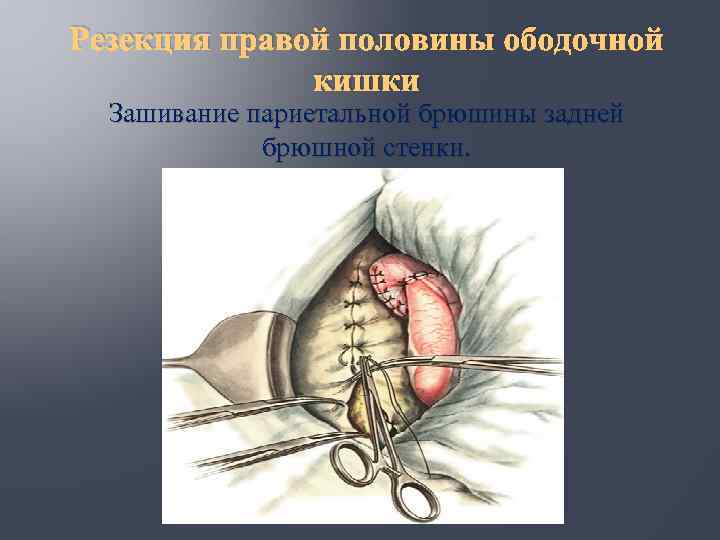 Резекция правой половины ободочной кишки Зашивание париетальной брюшины задней брюшной стенки. 