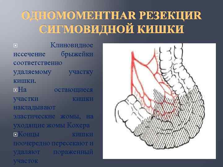 ОДНОМОМЕНТНАЯ РЕЗЕКЦИЯ СИГМОВИДНОЙ КИШКИ Клиновидное иссечение брыжейки соответственно удаляемому участку кишки. На остающиеся участки