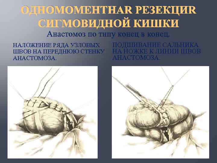 ОДНОМОМЕНТНАЯ РЕЗЕКЦИЯ СИГМОВИДНОЙ КИШКИ Анастомоз по типу конец в конец. НАЛОЖЕНИЕ РЯДА УЗЛОВЫХ ШВОВ