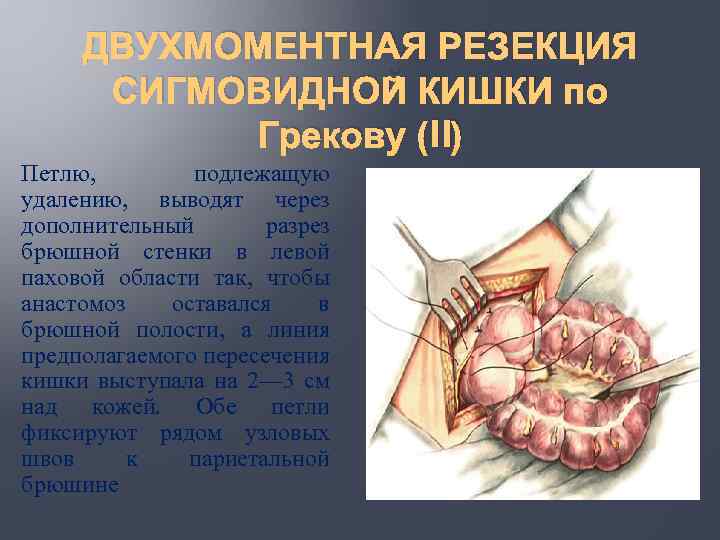 ДВУХМОМЕНТНАЯ РЕЗЕКЦИЯ СИГМОВИДНОЙ КИШКИ по Грекову (II) Петлю, подлежащую удалению, выводят через дополнительный разрез