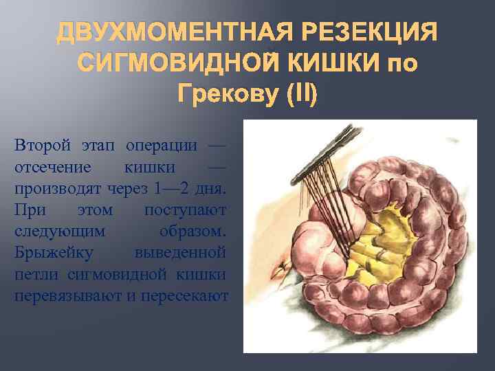 ДВУХМОМЕНТНАЯ РЕЗЕКЦИЯ СИГМОВИДНОЙ КИШКИ по Грекову (II) Второй этап операции — отсечение кишки —
