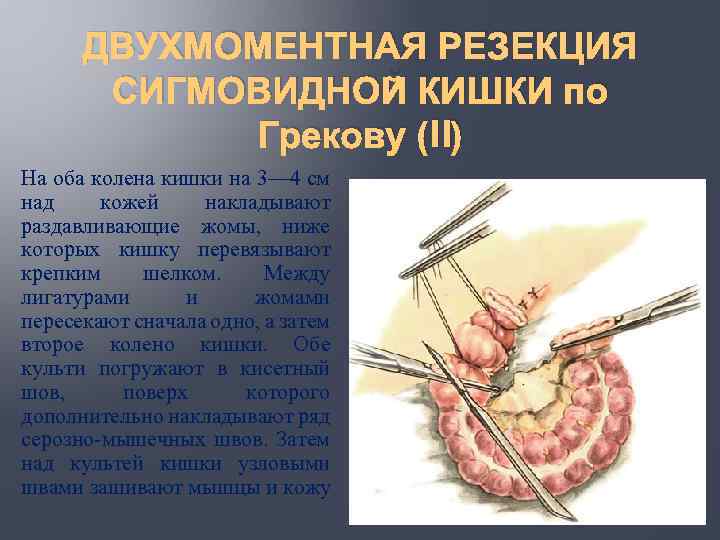 ДВУХМОМЕНТНАЯ РЕЗЕКЦИЯ СИГМОВИДНОЙ КИШКИ по Грекову (II) На оба колена кишки на 3— 4