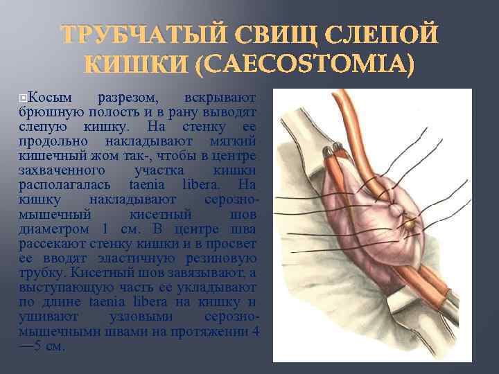 Перфорация слепой кишки что это