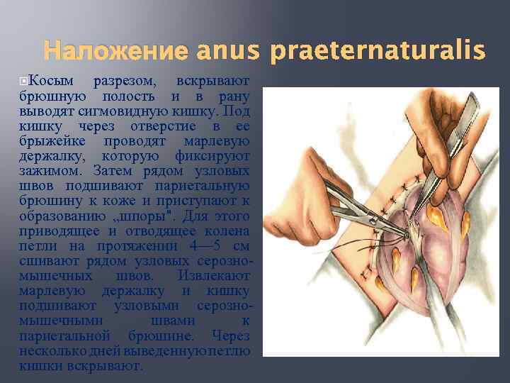 Наложение anus praeternaturalis Косым разрезом, вскрывают брюшную полость и в рану выводят сигмовидную кишку.