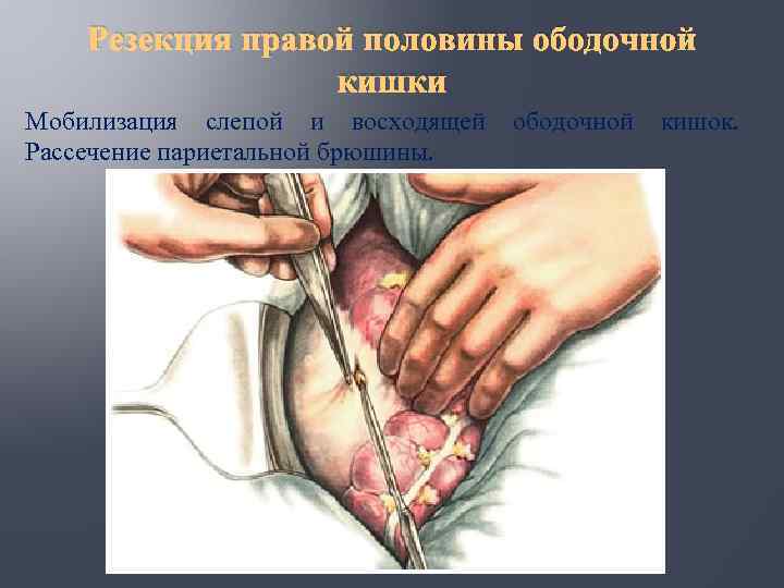 Резекция правой половины ободочной кишки Мобилизация слепой и восходящей Рассечение париетальной брюшины. ободочной кишок.