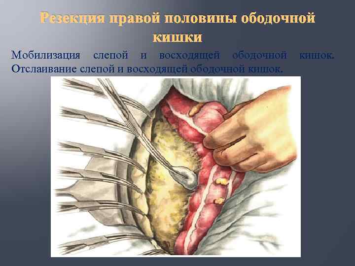 Резекция правой половины ободочной кишки Мобилизация слепой и восходящей ободочной Отслаивание слепой и восходящей