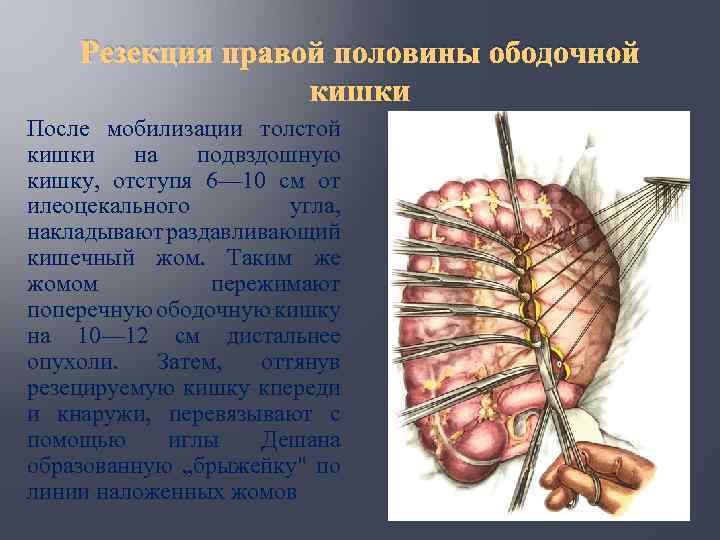 Резекция правой половины ободочной кишки После мобилизации толстой кишки на подвздошную кишку, отступя 6—