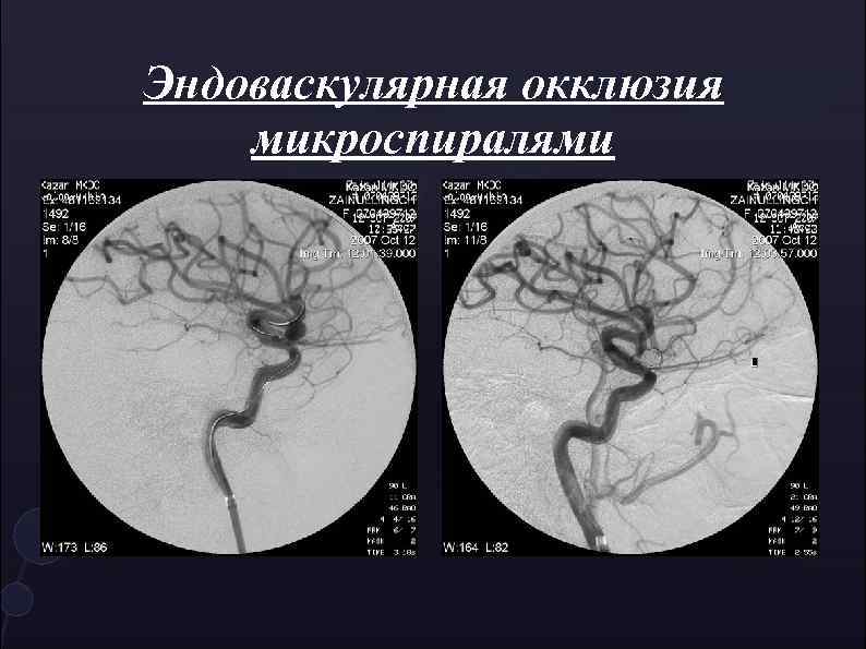 Эндоваскулярная окклюзия