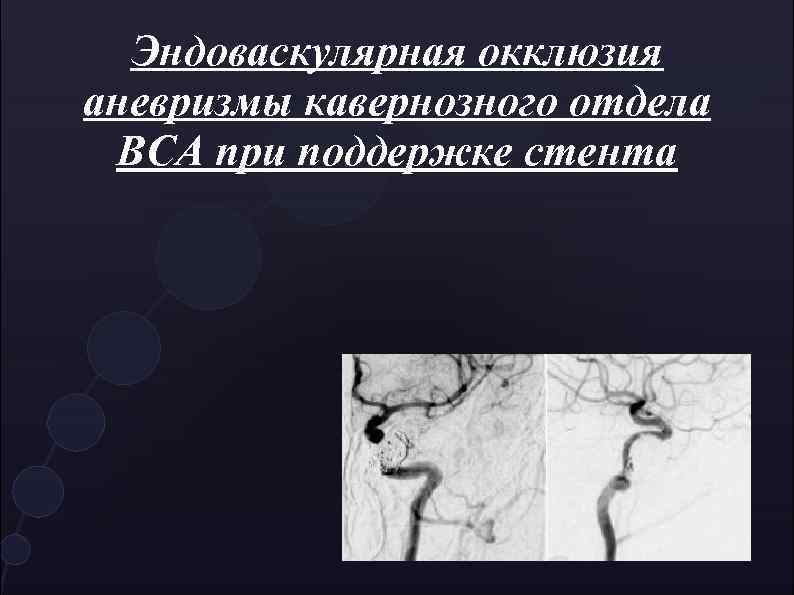 Эндоваскулярная окклюзия. Окклюзия аневризмы сосудов головного мозга. Эндоваскулярная окклюзия аневризм. Операция эндоваскулярная окклюзия аневризмы. Эндоваскулярная хирургия аневризм артерий головного мозга.