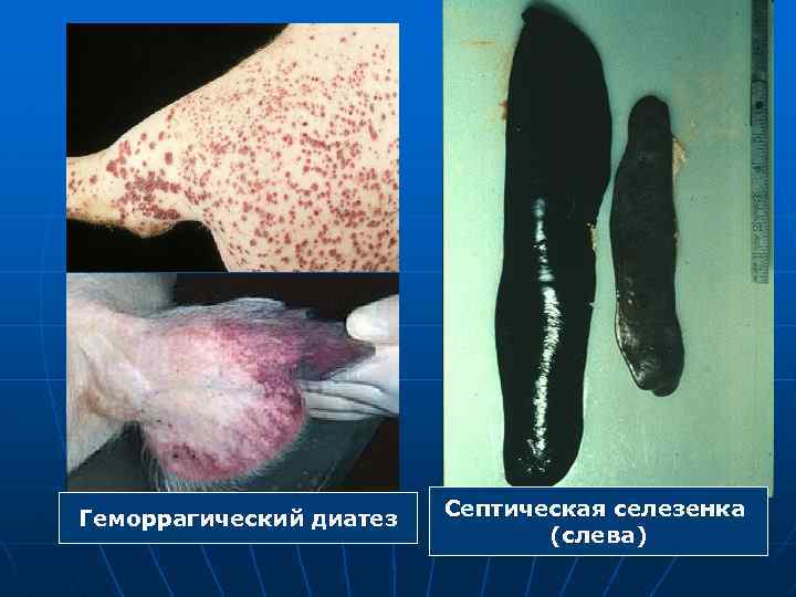 Геморрагический диатез Септическая селезенка (слева) 