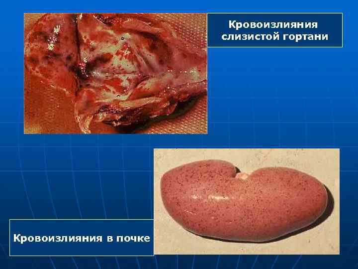Кровоизлияния слизистой гортани Кровоизлияния в почке 