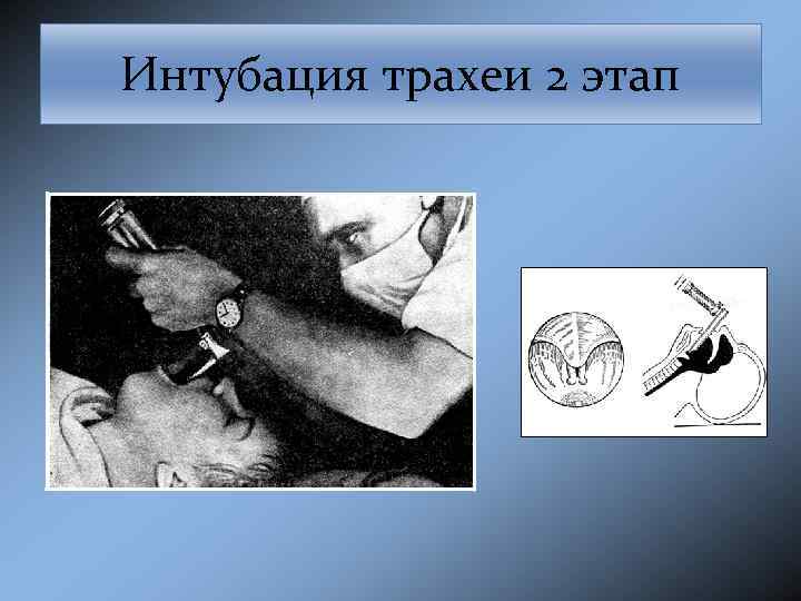 Интубация трахеи 2 этап 