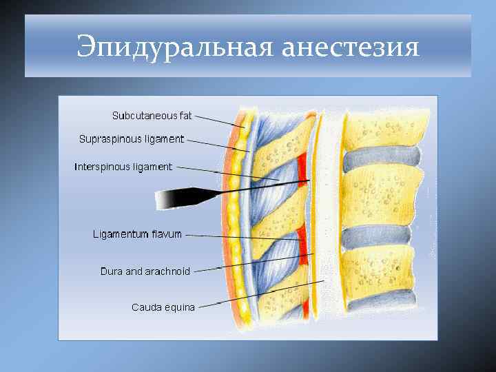 Эпидуральная анестезия что это