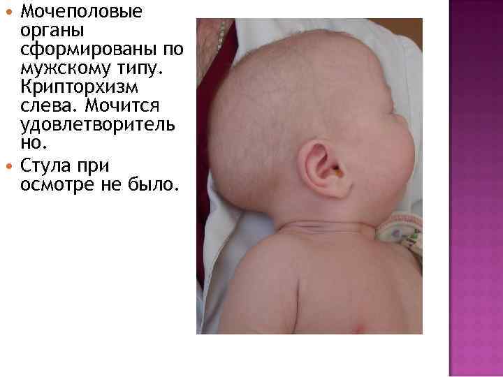  Мочеполовые органы сформированы по мужскому типу. Крипторхизм слева. Мочится удовлетворитель но. Стула при