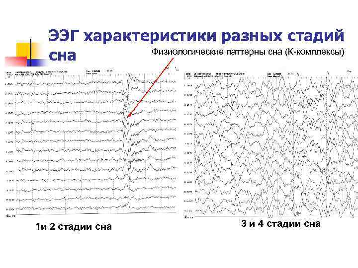ЭЭГ характеристики разных стадий Физиологические паттерны сна (К-комплексы) сна 1 и 2 стадии сна